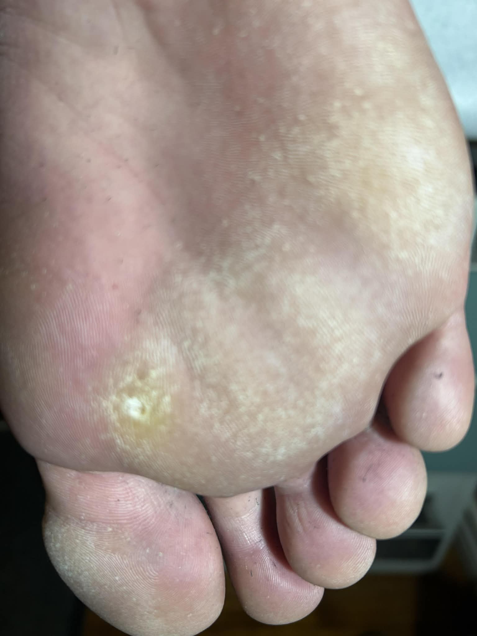 Example of a plantar wart