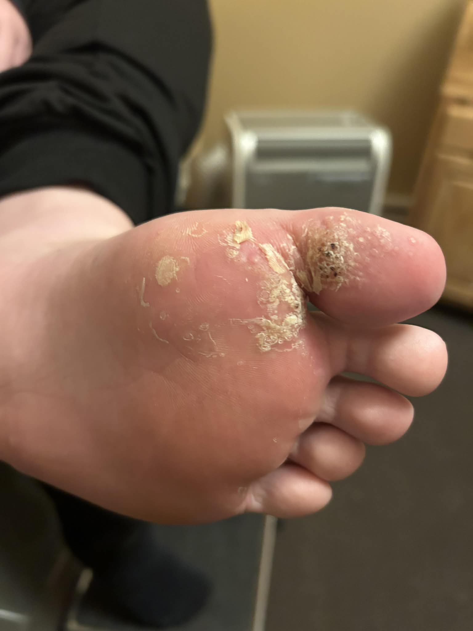 Example of a plantar wart