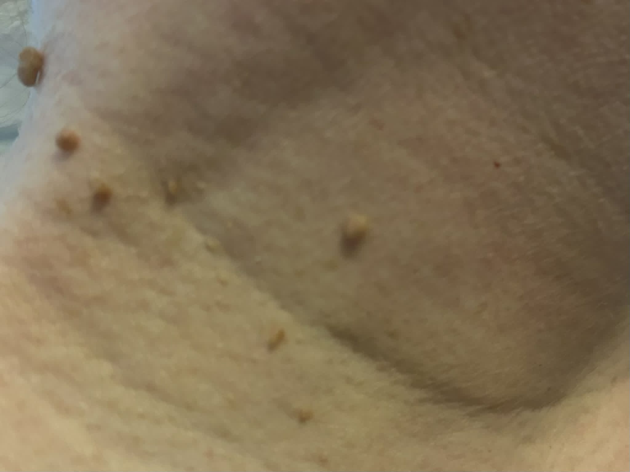 Example of a skin tag