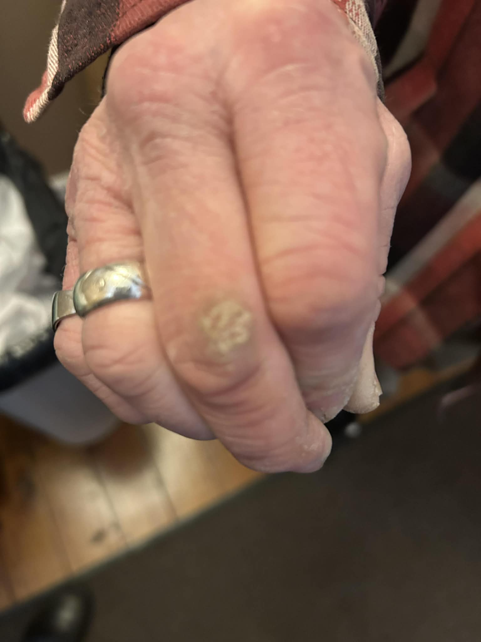 Example of a common wart